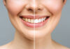 Clareamento Dental em Avaré: Opções Seguras e Modernas para Seu Sorriso