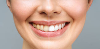 Clareamento Dental em Avaré: Opções Seguras e Modernas para Seu Sorriso