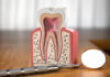 Tratamento de Canal em Itu – Soluções Avançadas em Endodontia